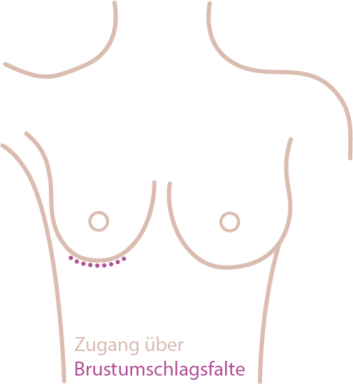 Brustvergrößerung: Zugang über Brustumschlagsfalte Brustvergrößerung: Zugang über Brustumschlagsfalte