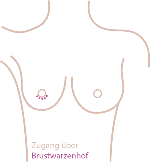 Brustvergrößerung: Zugang über Brustwarzenhof Brustvergrößerung: Zugang über Brustwarzenhof